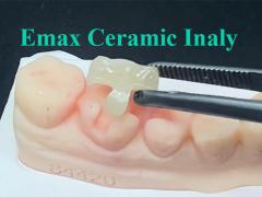 The Emax Ceramic inlay which is tailor-made precisely for its designated postion