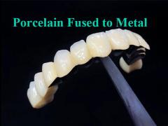 Porcelain Fused To Metal Crown Combining Durability and Beauty for Dental Health