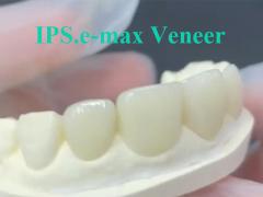 EMAX Veneer The Idea Solution for Durable and Aesthetic Dental Restorations