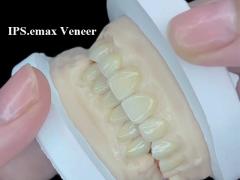 IPS.emax Veneer Premium Aesthetic Solution For Stunning Smile Transformations