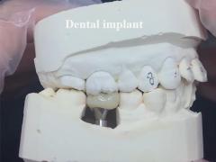 Dental Implant Crown Bridge