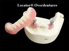 Locator Overdentures are designed to provide optimal stability and retention for tooth loss