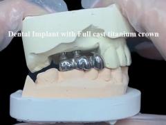 Full cast titanium crown Dental Implant molar for Missing Teeth Replacement