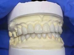 IPS EMAX Porcelain Veneers for Natural Looking Front Teeth Restorations