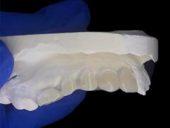 Custom Tailored Removable Denture for Enhanced Chewing and Speaking