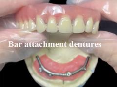 Bar Attachment Dentures The Secure and Convenient Removable Denture Solution with Implant Support