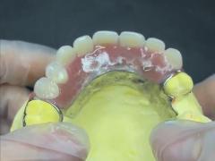 Easy Fit Cast Partial Denture Restores Chewing And Speaking Ability