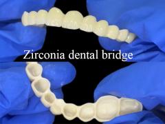 Zirconia Dental Bridge Strong and Natural Looking Restoration for a Seamless Smile