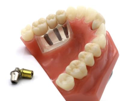 China High Esthetics Dental Implant Crown / Screw Retained Crown ISO Approved for sale