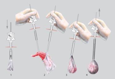 China Laparoscopic Surgery 10mm Endobag Specimen Retrieval for sale