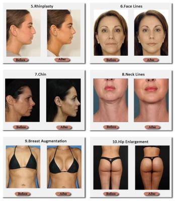 Κίνα Skinjection 10 Ml And 20 Ml Hyaluronic Breast Filler Korean Technnology 24 Mg/Ml προς πώληση