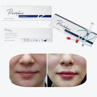 China Hyaluronic Acid Breast Filler de venta caliente para el aumento de labios con la mejor calidad en venta