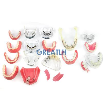 China Reusable Dental Teeth Model Removable Interior Mandibular Demo Overdenture with Upper and Lower Implants for Teaching Study for sale