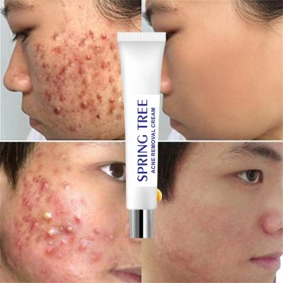 China Acne Treatment 2021 Best Selling Acne Treatment Organic Soft Anti Acne Herbal Cream - Acne Treatment 2021 Best Help for sale