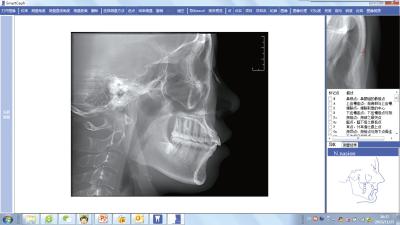 Cina Software Cephalometric collegato di misura per l'attrezzatura di tomografia computerizzata del fascio del cono di CBCT in vendita