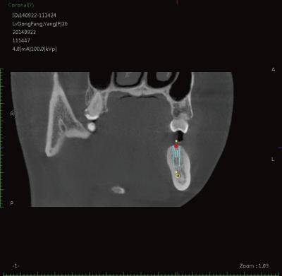 China Tamaño dental de los sistemas 0.125m m 0.25m m 0.075m m Voxel de la proyección de imagen de la clínica médica en venta