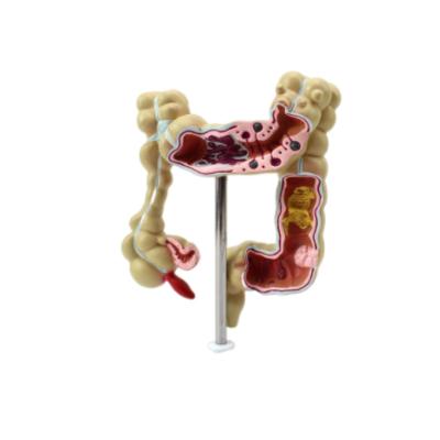 China Medical Science High Colon anatomical model of human intestine anatomical model grade and disease BIX-A1730 rectum model for sale