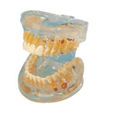 China BIX-L1008 School Pathological Tooth Transparent Model for sale