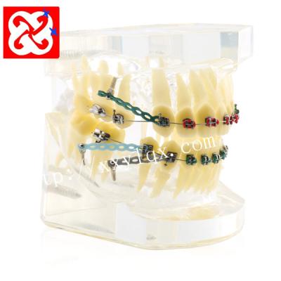 China Transparent Treatment Vivid Orthodontic Demonstration Model With Ortho Braces Ligation Wire Implant for sale