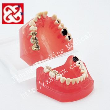 China Vivid caries treatment before and after comparison dental model with soft silicone gum with implant and fixed bridge for sale