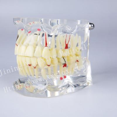 China Vivid Adult Pathological Disease Dental Model for Caries Calculus Implant and Impaction Treatment Dental Demonstration for sale