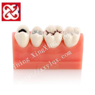 China Detailed anatomy structures putty and inlay caries treatment and demonstration model for sale