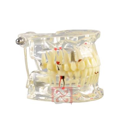 China Meidcal University Anatomical Oral Tooth Pathology Model With Caries Clear Color With Natural Root for sale