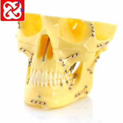 China Detailed anatomy structures fixed fracture with titanium plate and ortho implant dental skull model for sale