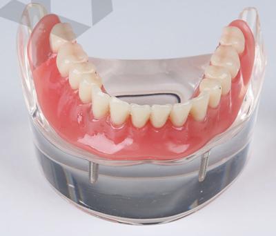 China Detailed Anatomy Structures Mandibular Overdenture Restoration Dental Model with 2 Implants for sale