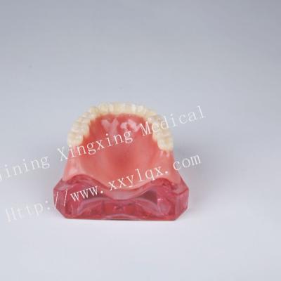 China Hospital Clinic University Upper Overdenture Subordinate With 4 Implant for sale