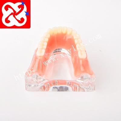 China Detailed Anatomy Structures Overdenture Implant Model With Silver Gold Bar for sale