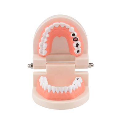 China PVC Dental Teeth Model 1:1 Child Children Teeth Small Tooth Decay Model Model for sale