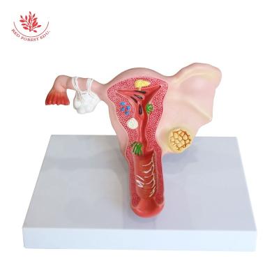 China Medical Educational Science and Gynecological Reproductive Medical Ovary Pathological Model Female Uterus Teaching Aids for sale