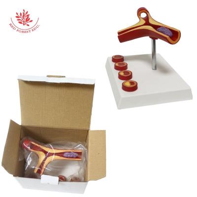 China Medical Educational Supply Anatomical Models Human Atherosclerosis Medical Supplies Vessel Vascular Model Magnified 50 Times for sale