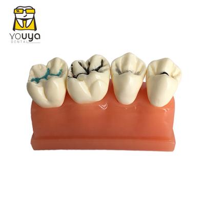 China Detailed anatomy structures four times pit and fissure sealment model dental model for sale