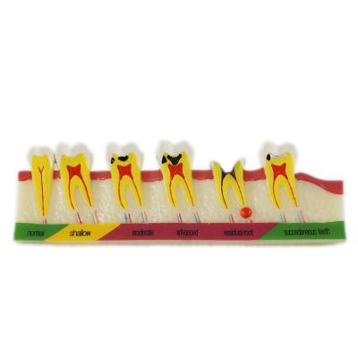 Китай Dental Peridontal Diseases Developing Model продается