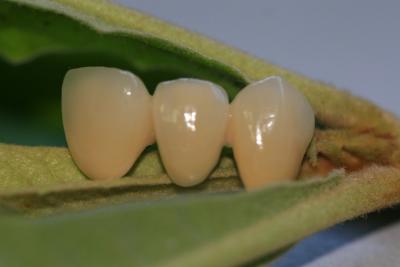 China Buena Biocompatibility PFM corona dental no preciosa de ISO13485 en venta