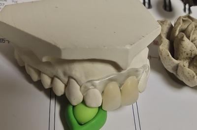 Китай Временный мягкий и эластичный Denture Valplast невидимый продается