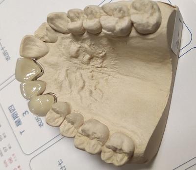 China Buena corona dental matálica-cerámica de la aptitud PFM en venta