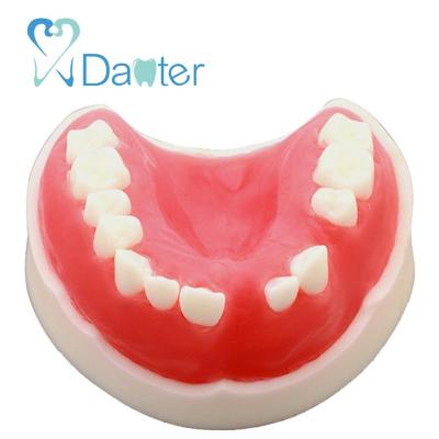 China Hospital Clinic University Well Sell Dental Implant Partially Edentulous Model For Dental Practice for sale