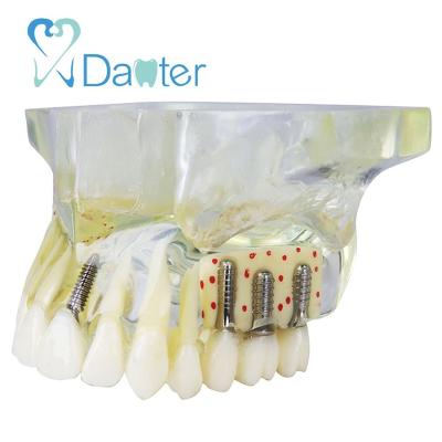 China Hospital Clinic University Best Sell Dental Upper Teeth Implant Model With White Teeth And Bone For Demonstration for sale