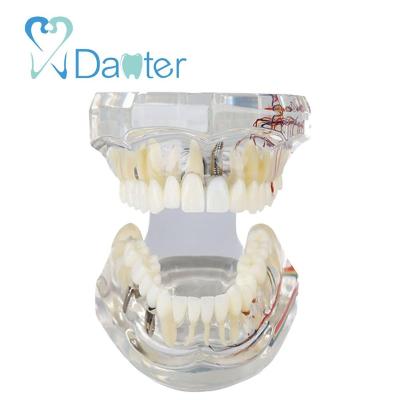 China Hospital Clinic University A200-2 All In One Dental Implant Model With Removable Nerve And Teeth Crown Bridges for sale