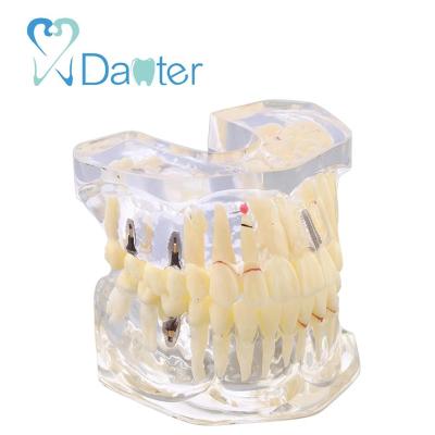 China Hospital Clinic University China Manufacture Dental 2 Times Implantand Model And Restoration Model For Demonstration for sale