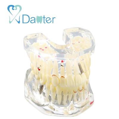 China 2 Fold Dental Pathological Model Hospital Clinic University with Caries for Hospital and School for sale