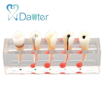 China High Quality Dental Root Canal University Clinic Hospital Terapy Treatment Endodontic Model for sale