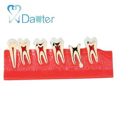 China Hospital Clinic University Factory Price Dental Caries Illustration Teeth Model for sale