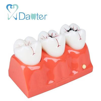 China Hospital Clinic University Type New Teeth Caries Pathological Model Dental Model For Dental Study for sale