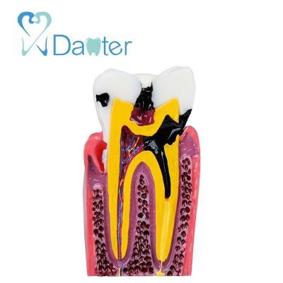 China High Quality Hospital Clinic University Caries Tooth Model for Dentist Patient Communication for sale