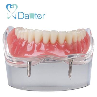 China Hospital Clinic University Dental Inner Overdenture Mandibular Lower With 2 Implants Restoring Teeth Study Teaching Model for sale