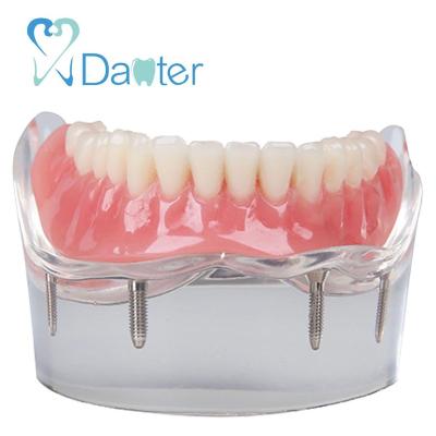 China Hospital Clinic University Most Popular Dental Model Mandibular Overdenture Model With 4 Implants for sale